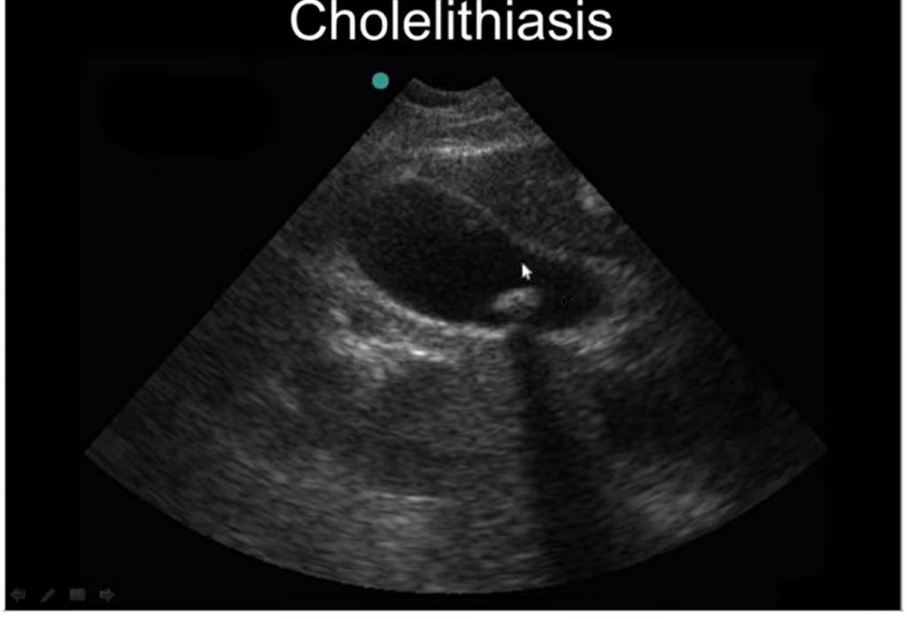 Ultrasound Scan of Biliary showing Acoustic Shadow phenomenon