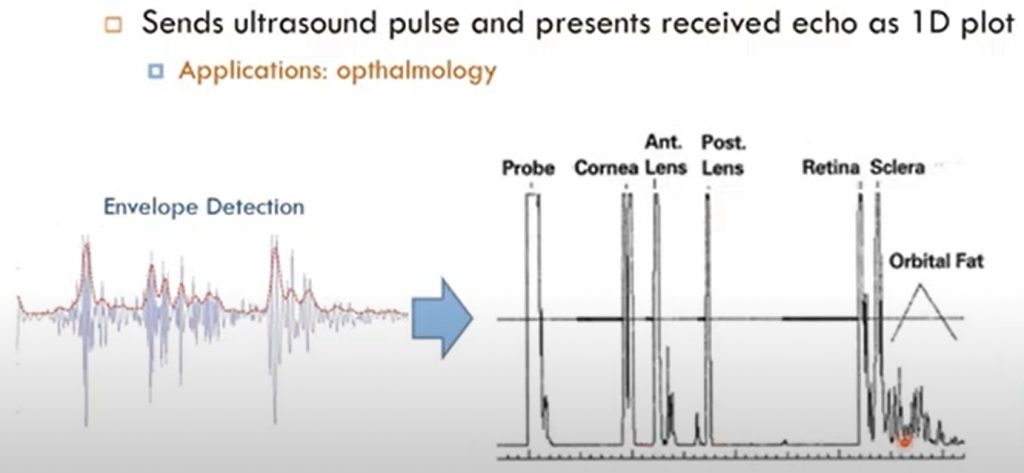 A pciture depicting A Mode in Ultrasound