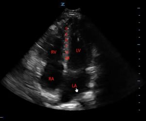 Labeled Apical Four Chamber Views during Echocardiography