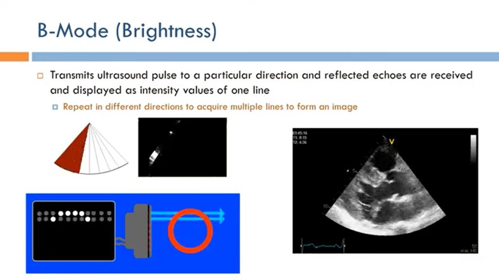 Image Depicting B mode in Ultrasound