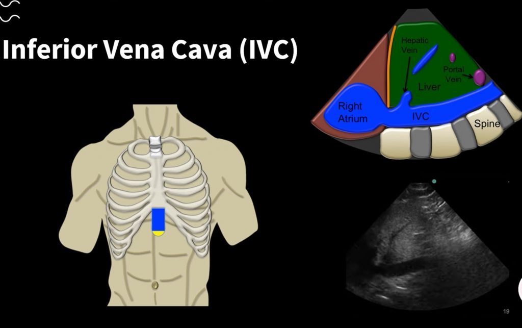 Probe Placement and Anatomy in Inferior Vena Cava View during Echocardiography