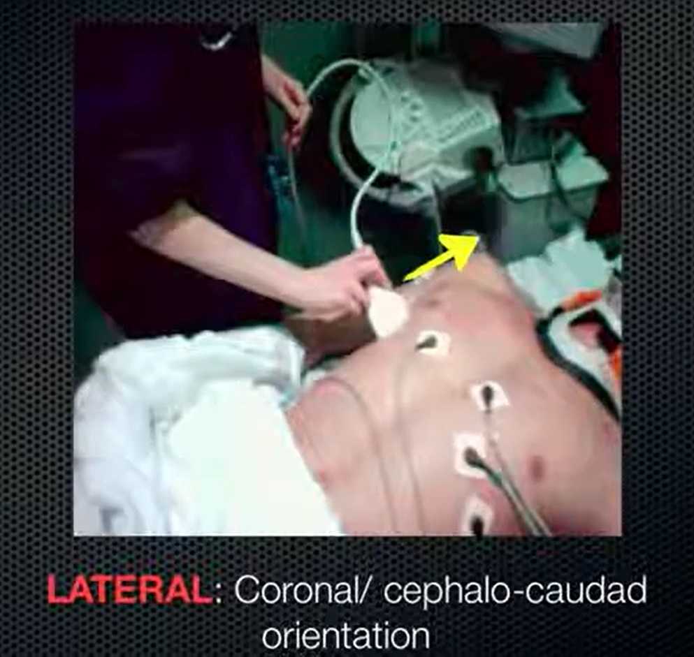 Lung Ultrasound Placement at Lateral Chest