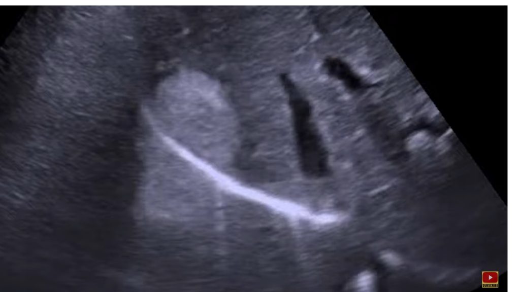 Ultrasound of Diaphragm showing mirror artefact