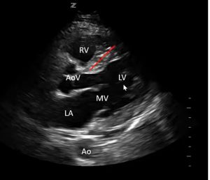 ECHO VIEW ON PARASTERNAL LONG AXIS