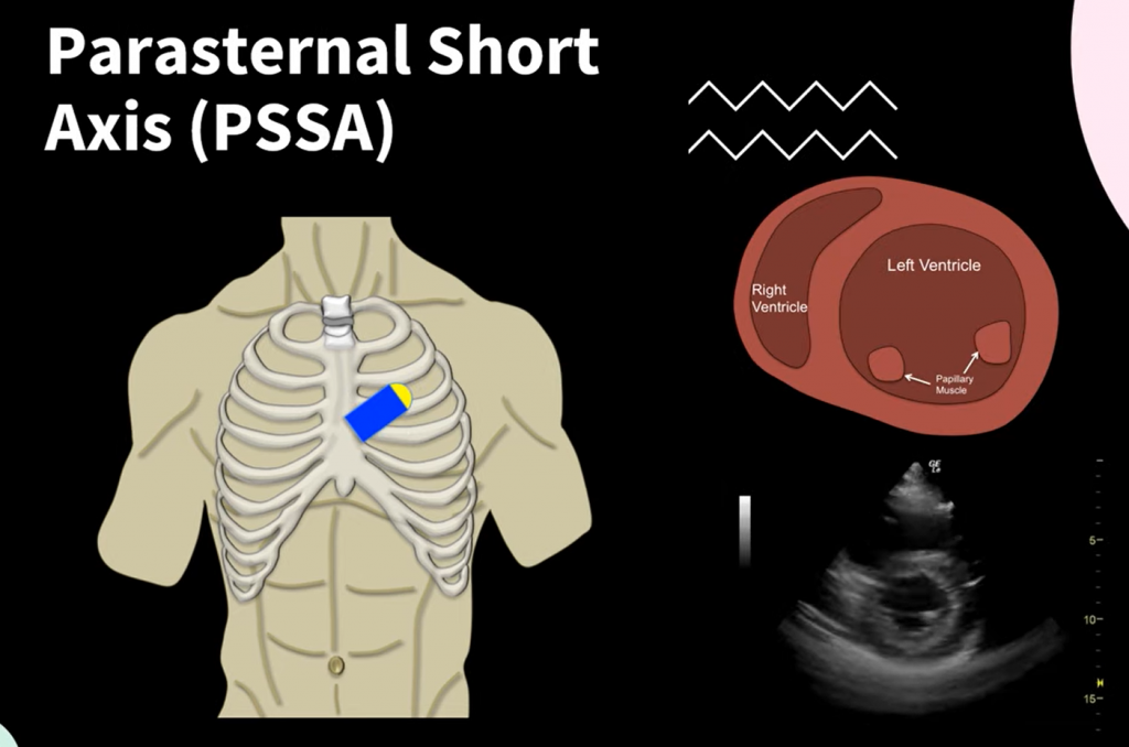 Parasternal Short Axis Probe Placement and Anatomy in Echocardiography