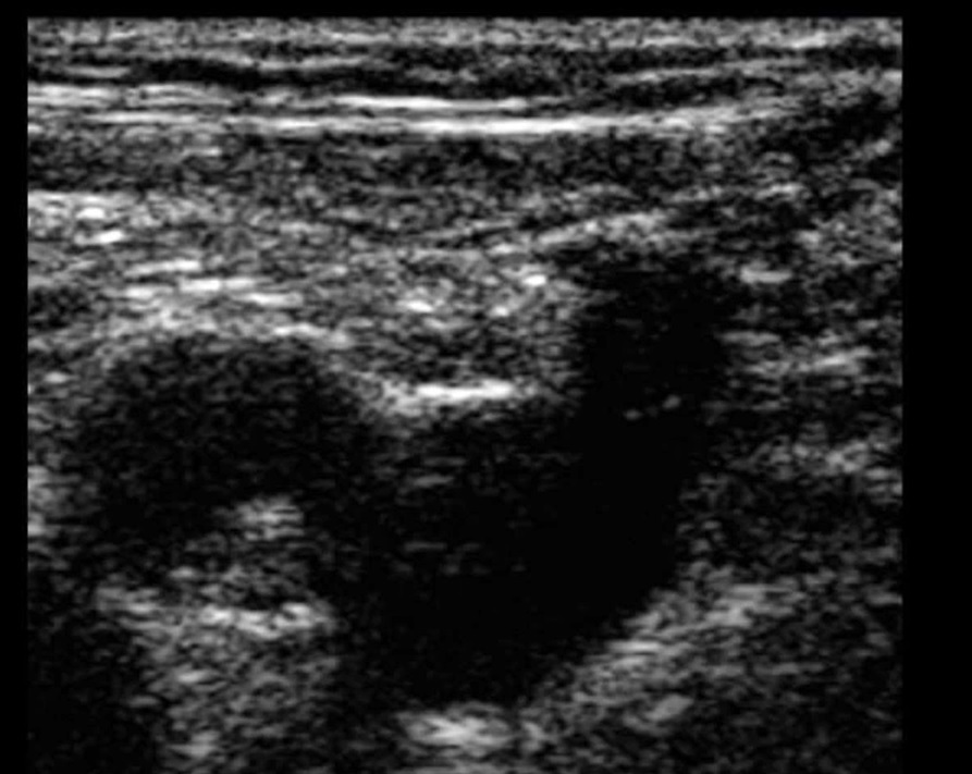 Image showing refraction artefact in vascular ultrasound