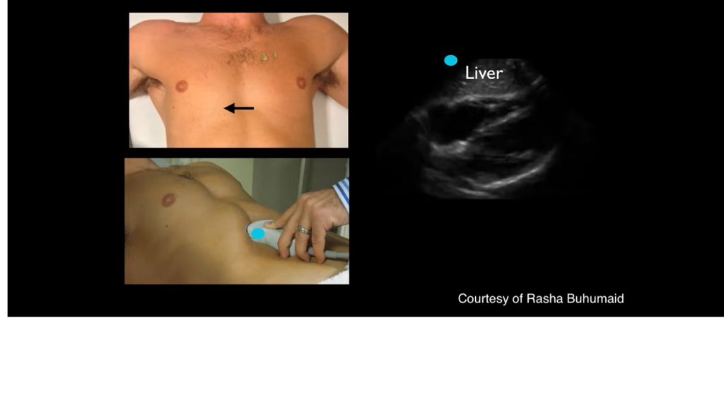 Image showing Subxiphoid window in FAST scan