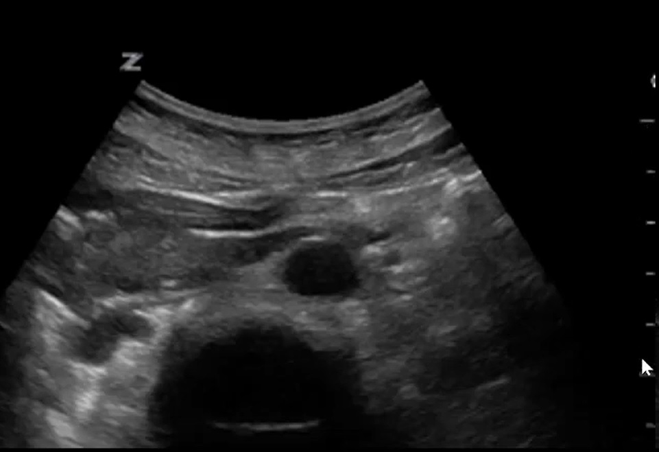 Abdominal aorta scan showing screen indicator mark on the right side