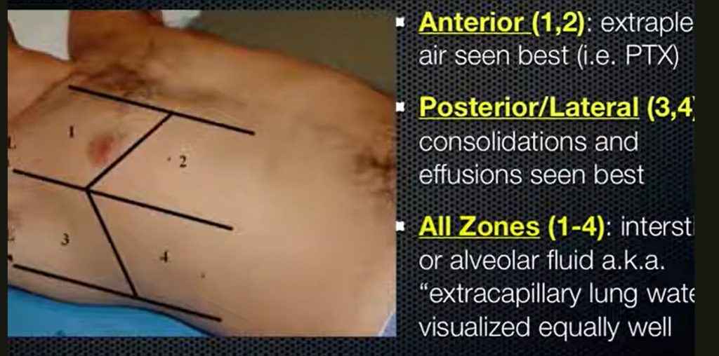 Probe placement in LUS according to zones