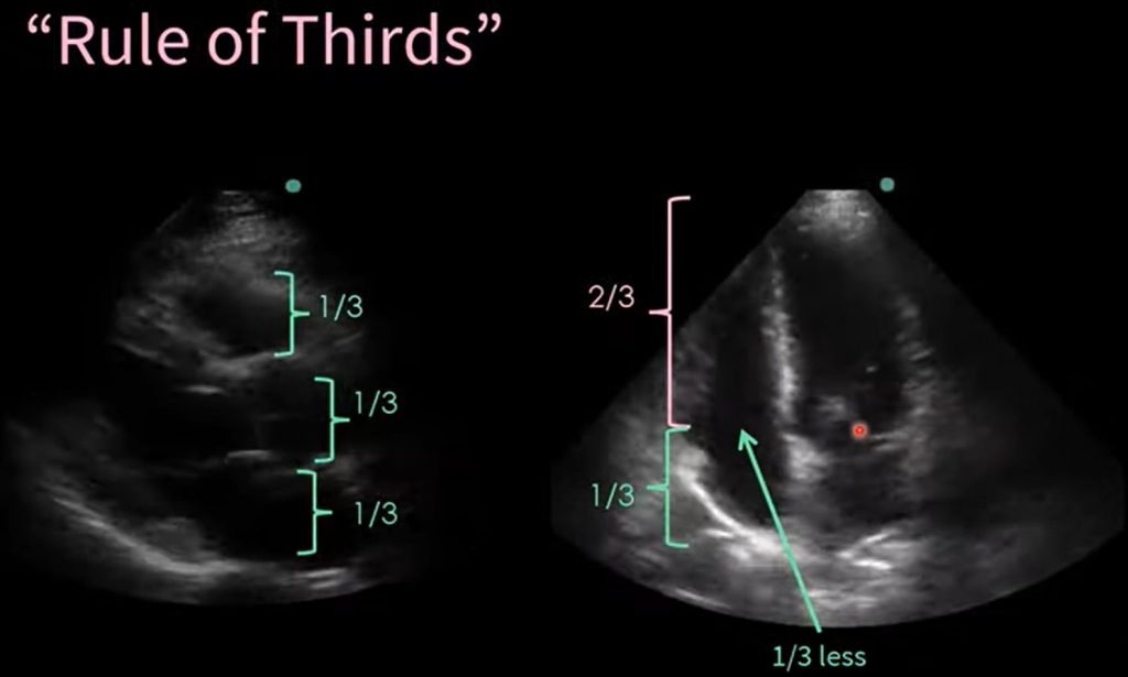 Rule of third application when estimating normal size of chambers in Echo